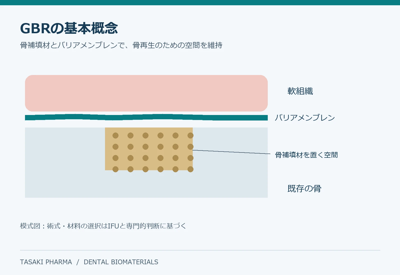 GBRにおけるバリアメンブレンと骨補填材の概念図